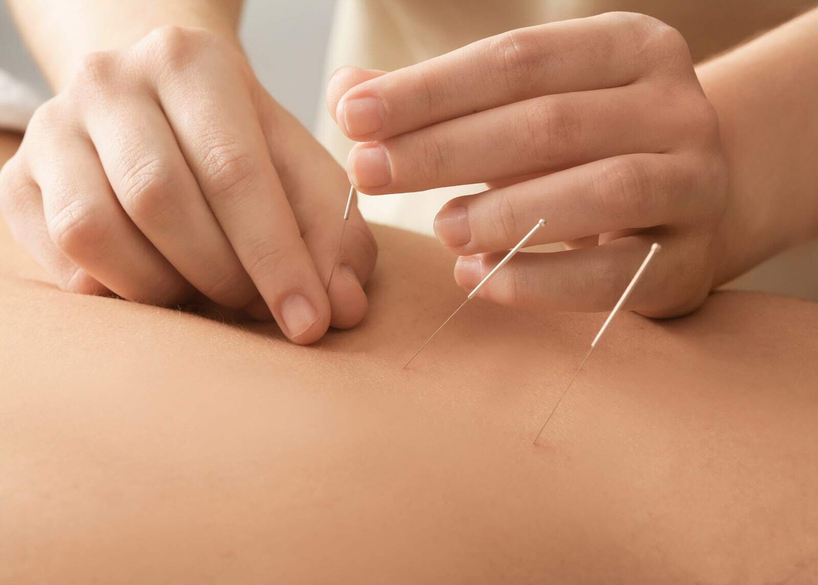 Acupunctură București: întrebări și răspunsuri despre acupunctură