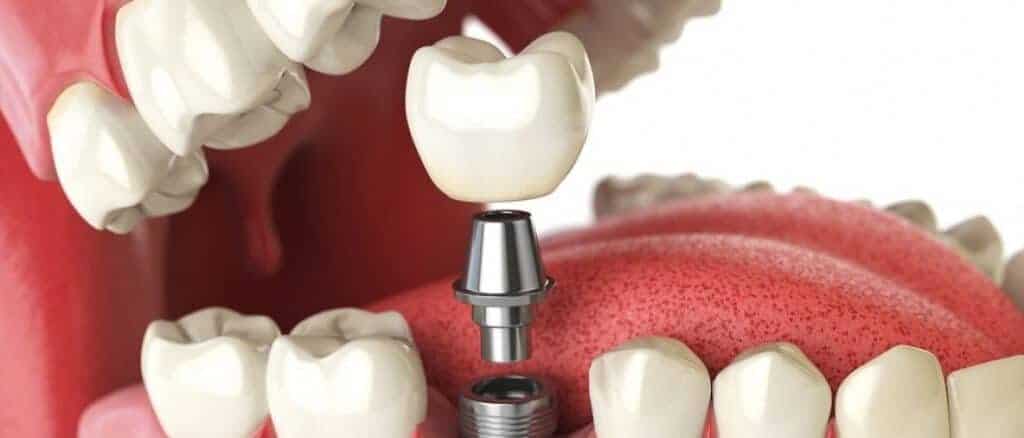 5 Motive pentru care și tu ar trebui să-ți înlocuiești dinții lipsă cu implanturi dentare