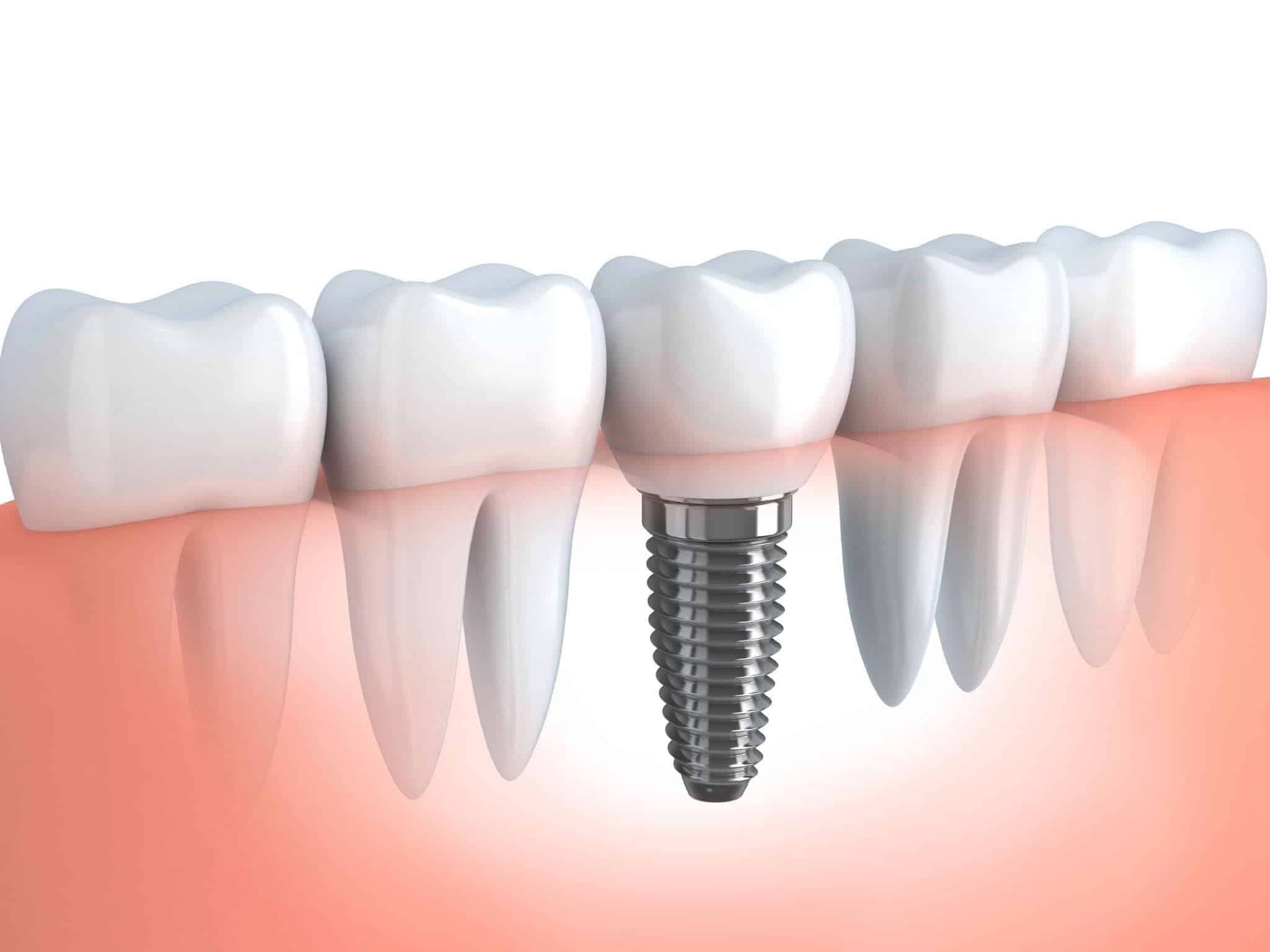 Când ar trebui să ai un implant dentar?