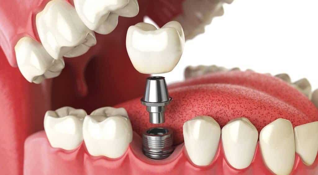 Ce se întâmplă dacă nu apelezi la timp pentru un implant dentar în cazul pierderii unui dinte?