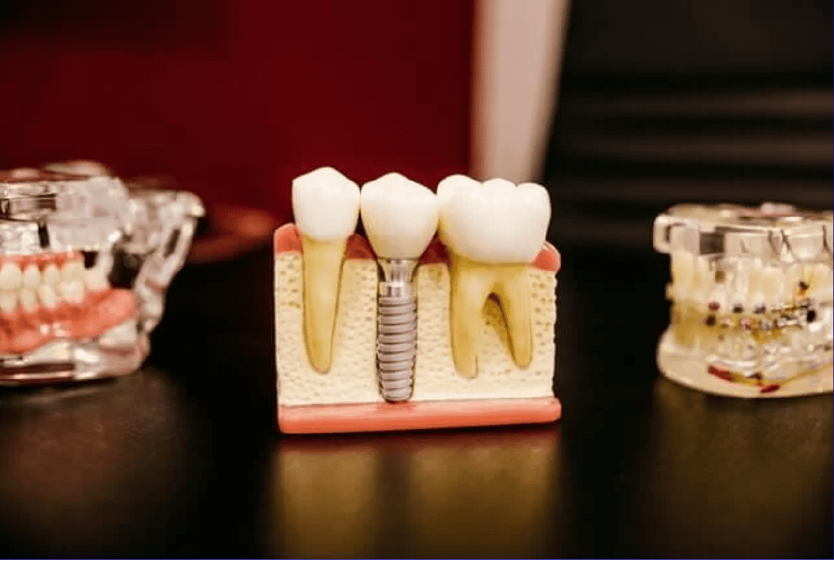 Ce rol au implanturile dentare și ce trebuie să știi despre ele?