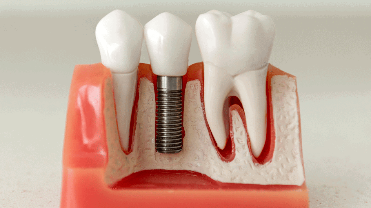Implantul dentar – intervenție care crește calitatea vieții