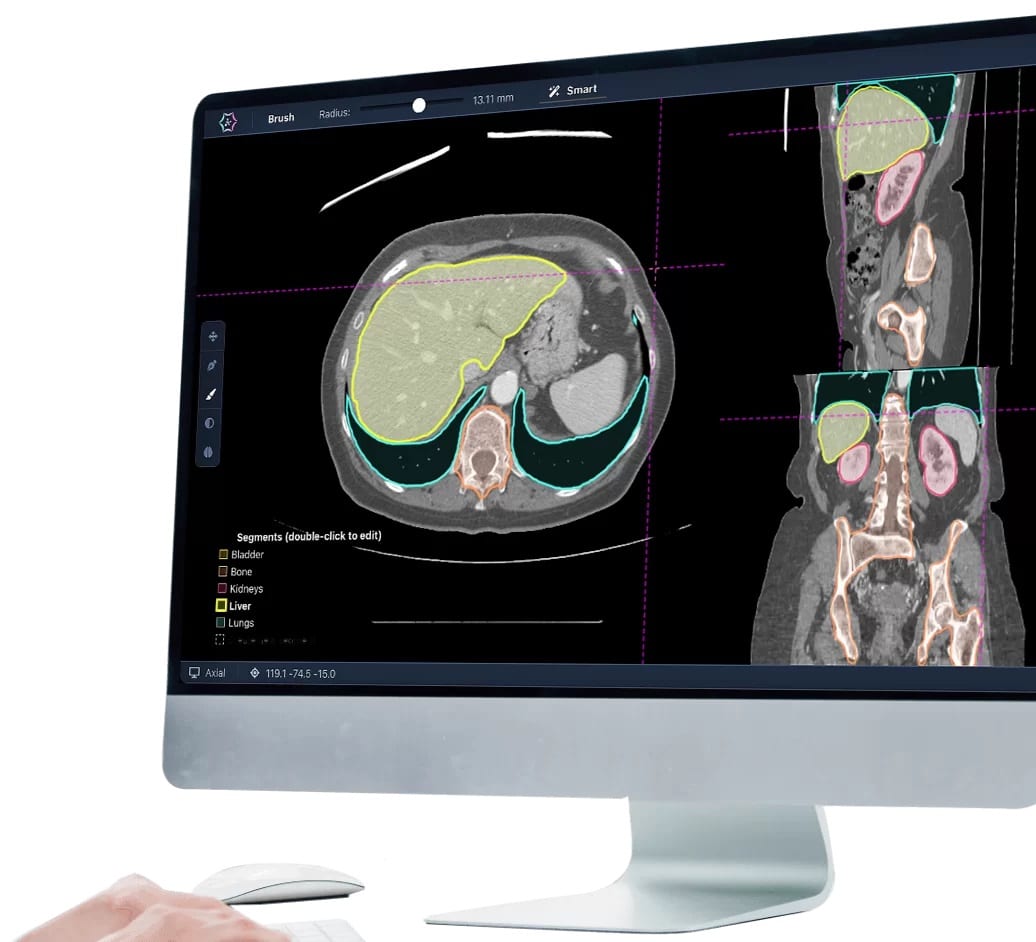 O echipă clujeană de luptă împotriva cancerului care revoluționează screeningul oferă acțiuni la start-up investitorilor care se alătură luptei