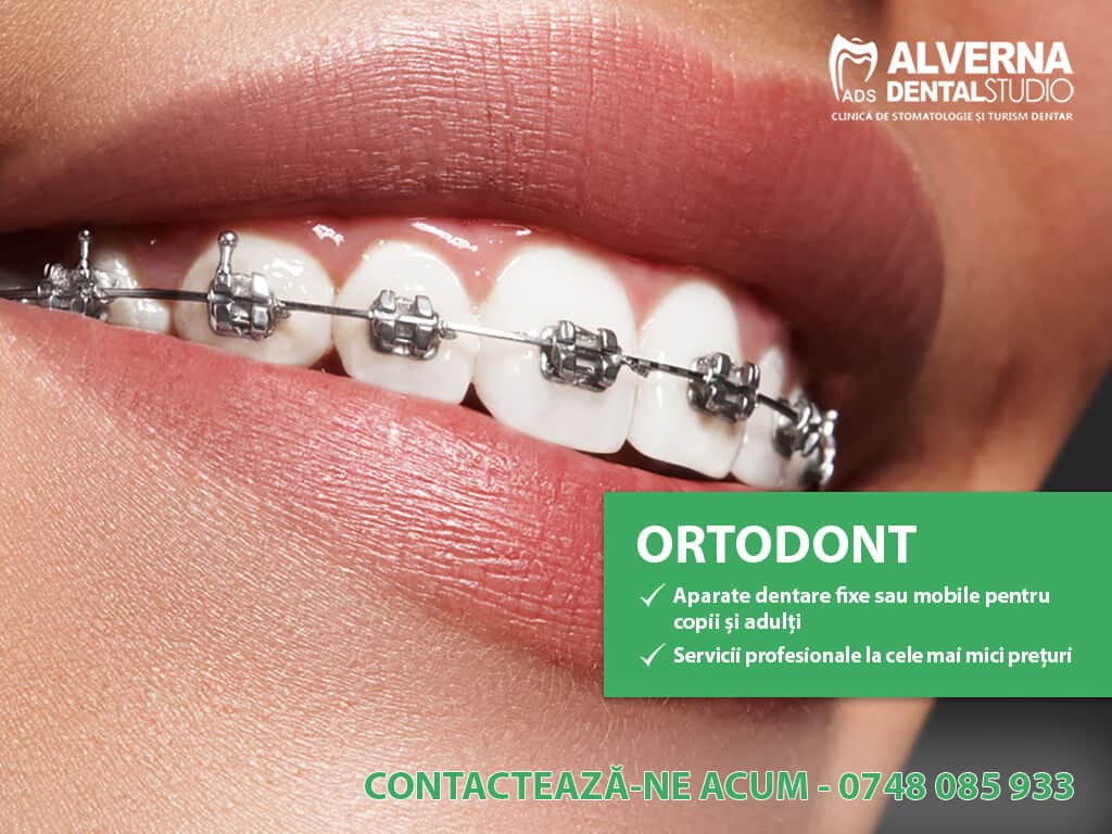 Mituri despre aparatele dentare