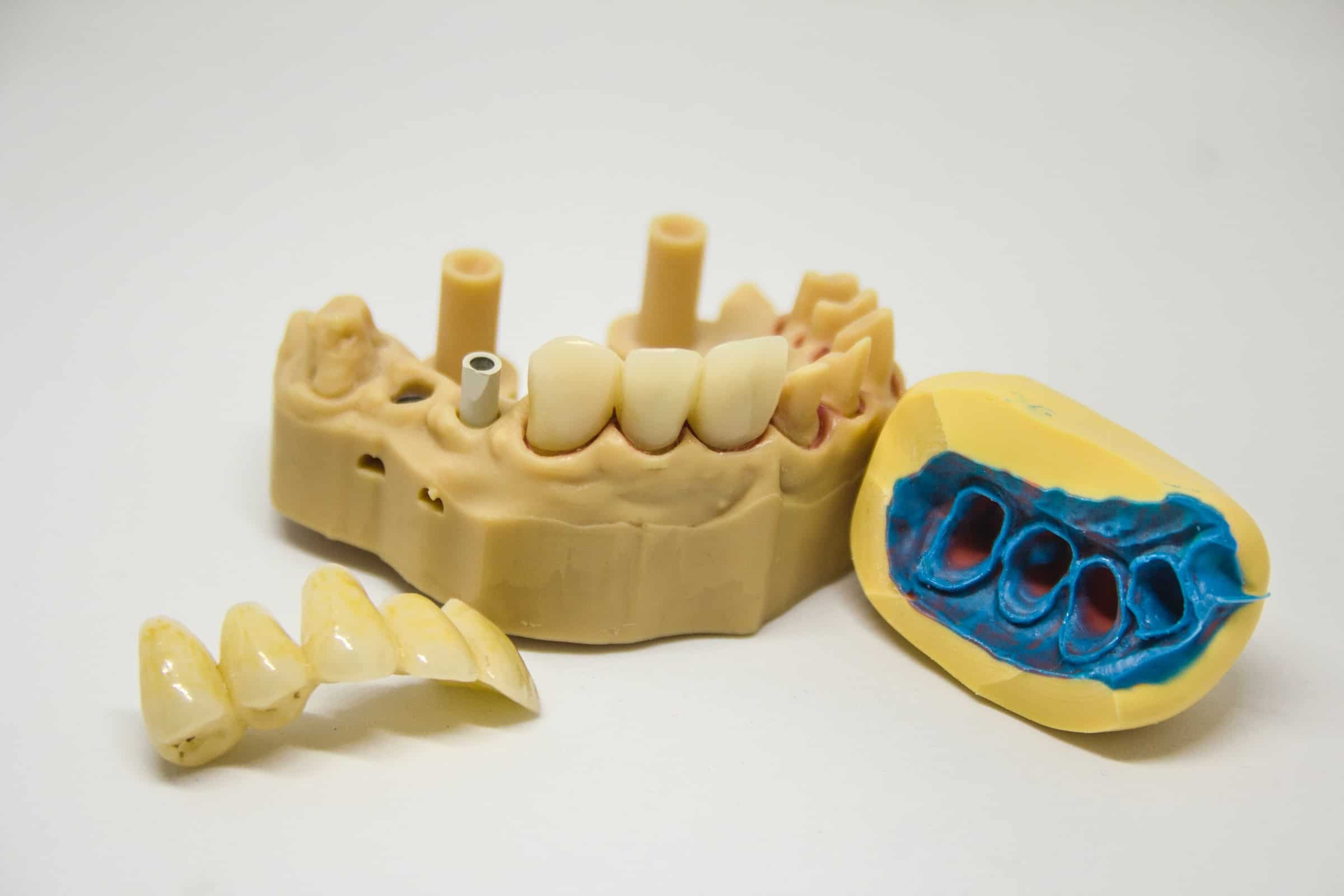 Ce trebuie sa faci pentru a avea grija de implantul dentar?