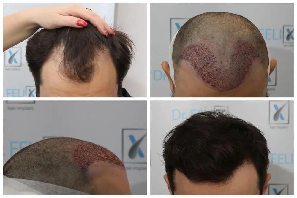 Transplant de par de calitate și condiții excelente la Dr. Felix Hair Implant
